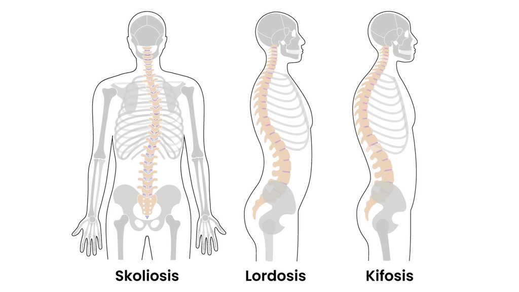 Pada penderita lordosis lekukan tulang belakangnya terlalu menjorok ke